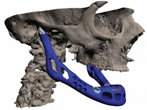Имплант напечатан на 3D-принтере